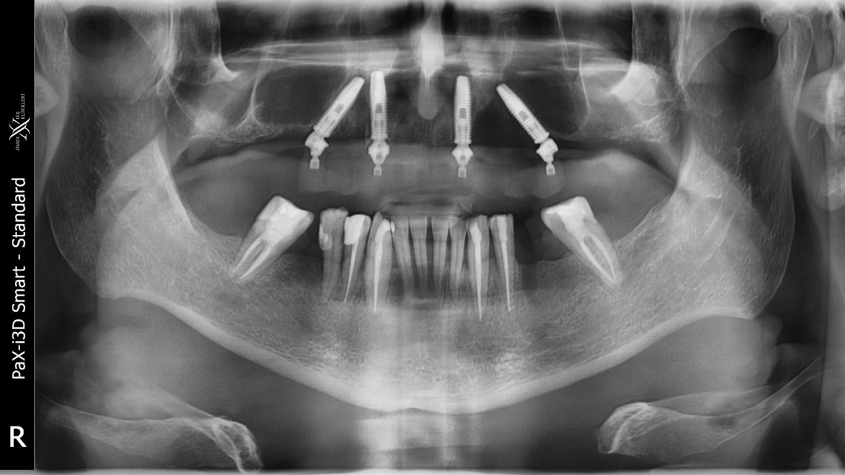 Dental Tomografi ile Panoramik Film Arasındaki Farklar Nelerdir?